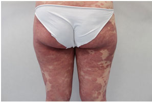 Una strana dermatite eritemato-desquamativa diffusa e persistente