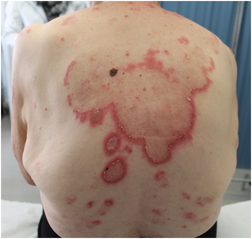 Eruzione LUPUS-LIKE indotta da farmaci ANTI-HER2 – Scuola Dermatologica  Chimenti