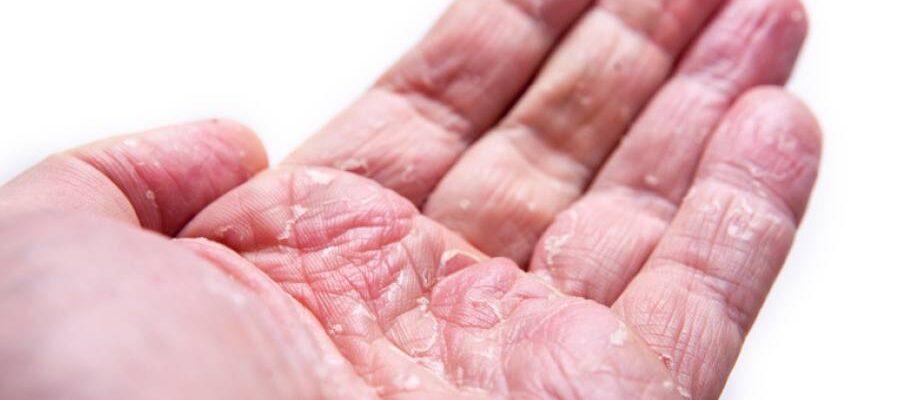 L’utilizzo dell’alitretinoina nella dermatite cronica delle mani: esperienza di un centro dermatologico canadese