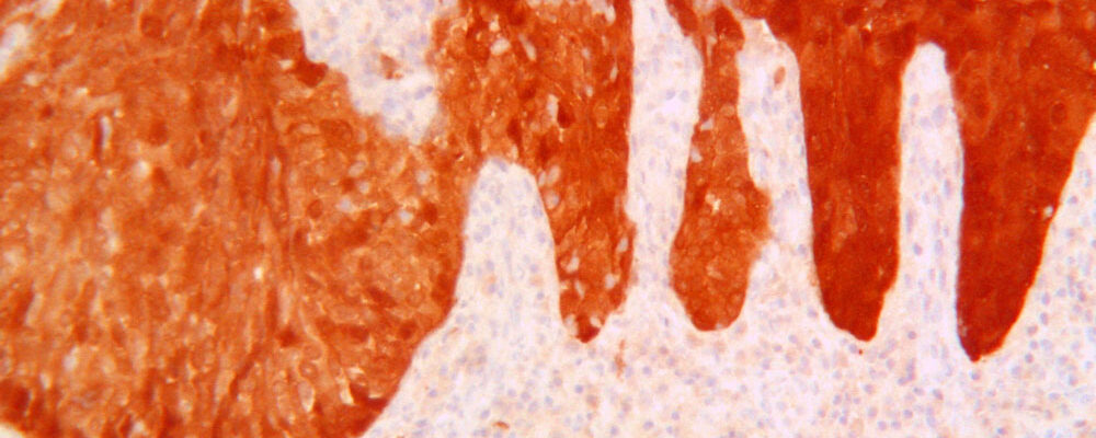 Carcinoma squamocellulare basaloide HPV-correlato del pene