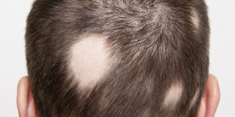 Novità nel trattamento dell’alopecia areata: arrivano gli inibitori delle Janus Chinasi