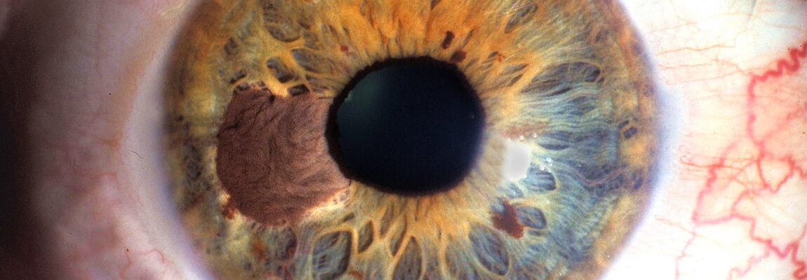 Il melanoma oculare: iter diagnostico e terapeutico