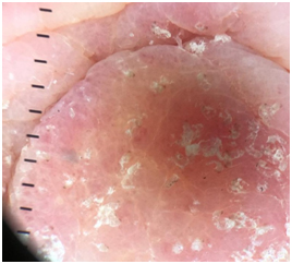 Eruzione eritematosa generalizzata in paziente immunodepressa: scabbia norvegese