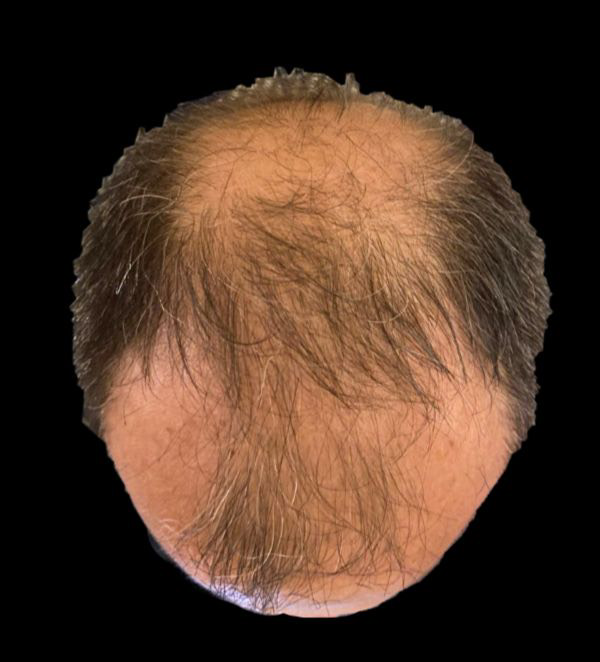 Alopecia Androgenetica: dalla patogenesi agli ultimi trials clinici