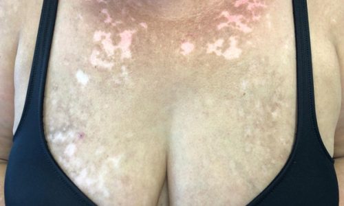 Reazione vitiligo-like indotta da terapia con Ribociclib