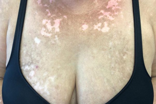 Reazione vitiligo-like indotta da terapia con Ribociclib