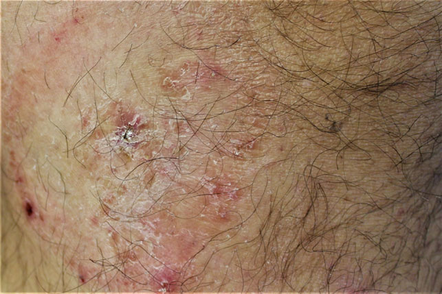 Un caso di dermatofitosi da Tricophyton rubrum