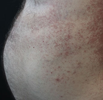 Granuloma attinico in un paziente con Dermatite Atopica adult-onset