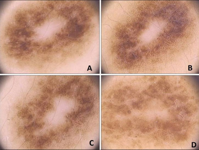 Strutture e pattern dermoscopici di nevi melanocitici acquisiti e loro evoluzione nell’età pediatrica