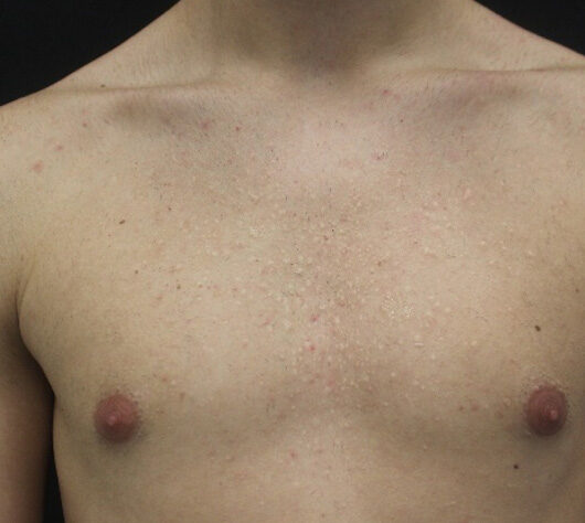 Multiple lesioni papulari biancastre diffuse al tronco