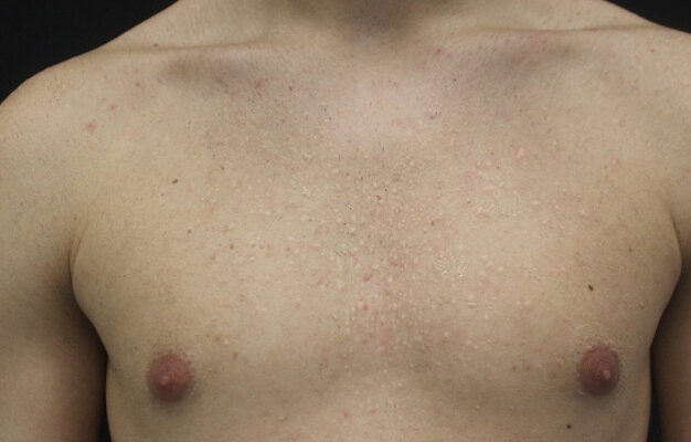 Multiple lesioni papulari biancastre diffuse al tronco
